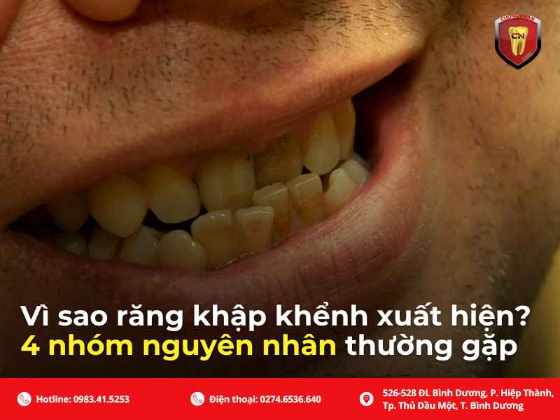 Vì sao răng khập khểnh xuất hiện ? 4 nhóm nguyên nhân thường gặp
