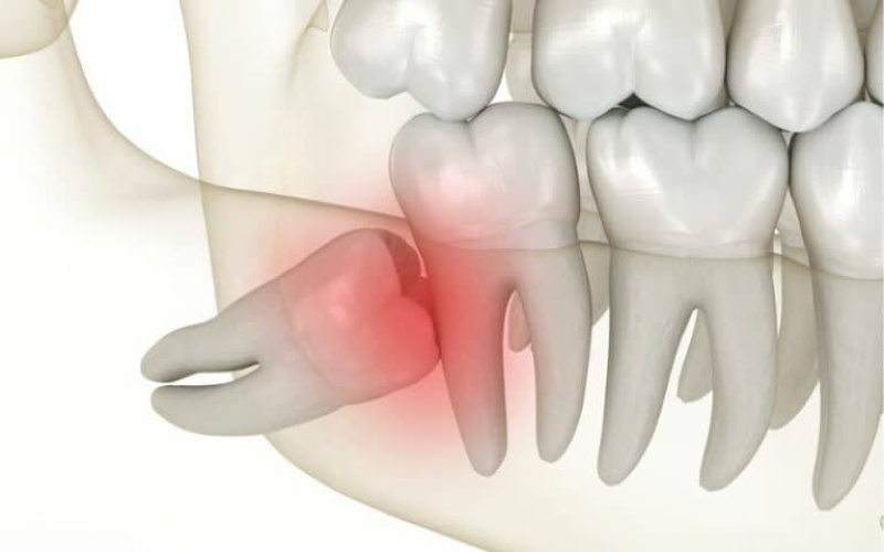 Răng khôn mọc ngầm là gì mà sao người trưởng thành hay gặp?