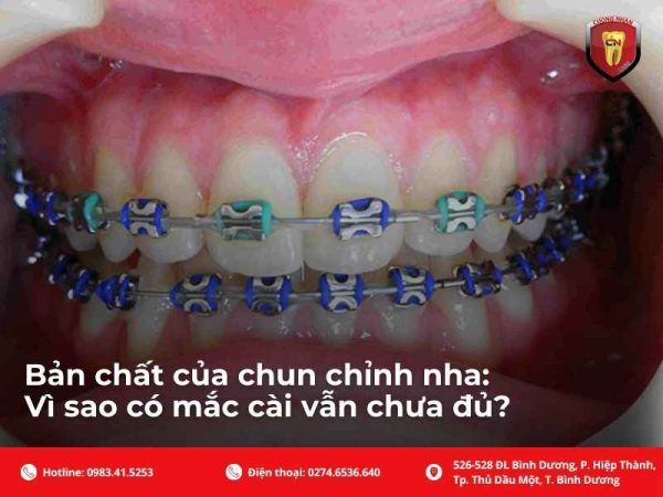 Bản chất của chun chỉnh nha: Vì sao có mắc cài vẫn chưa đủ?