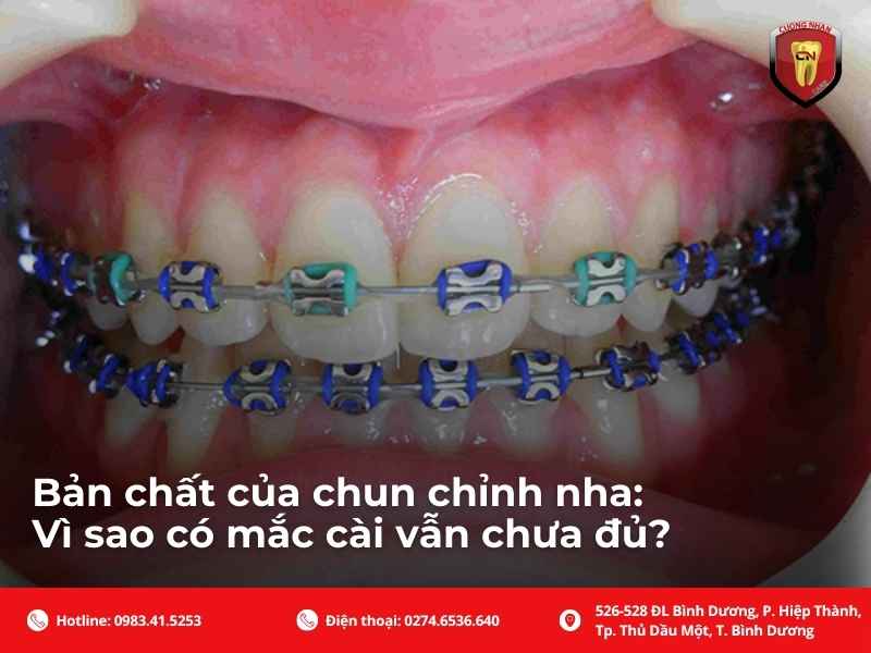 Bản chất của chun chỉnh nha: Vì sao có mắc cài vẫn chưa đủ?