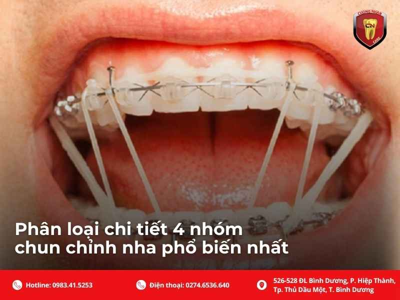 Phân loại chi tiết 4 nhóm chun chỉnh nha phổ biến nhất