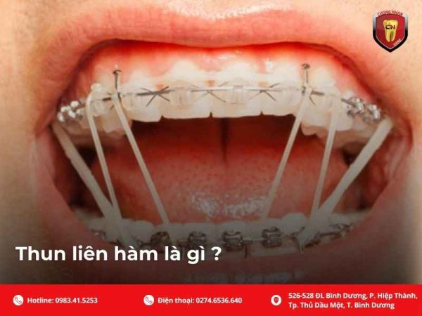 Cách đeo thun liên hàm đúng tại nhà: hướng dẫn theo hạng II, hạng III, thun cắn chéo, thun hộp, lỗi thường gặp và thời gian đeo.