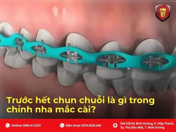 Trước hết chun chuỗi là gì trong chỉnh nha mắc cài?