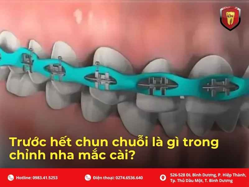 Trước hết chun chuỗi là gì trong chỉnh nha mắc cài?