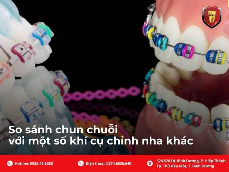 So sánh chun chuỗi với một số khí cụ chỉnh nha khác