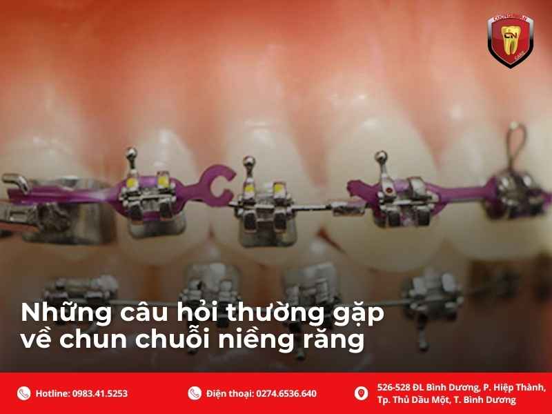 Những câu hỏi thường gặp về chun chuỗi niềng răng