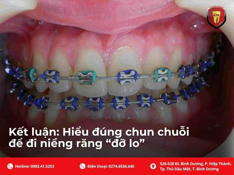 Kết luận: Hiểu đúng chun chuỗi để đi niềng răng “đỡ lo”