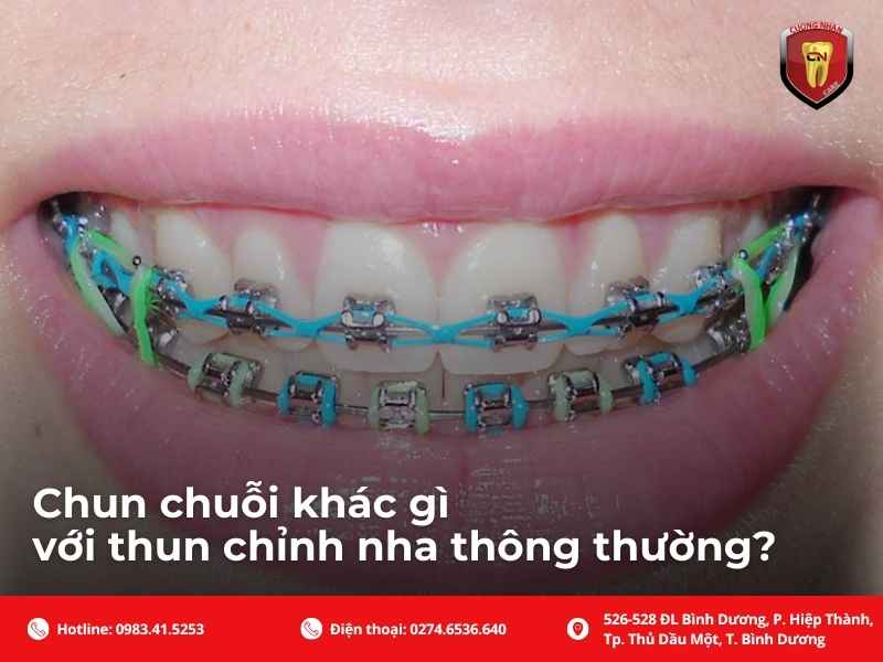 Chun chuỗi khác gì với thun chỉnh nha thông thường?