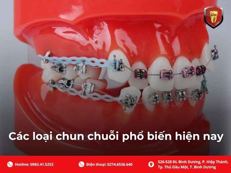Các loại chun chuỗi phổ biến hiện nay
