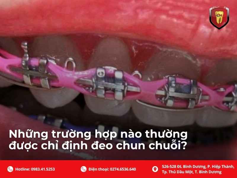 Những trường hợp nào thường được chỉ định đeo chun chuỗi?