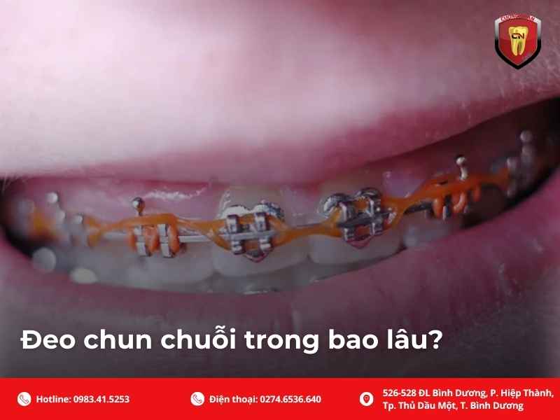 Đeo chun chuỗi trong bao lâu?