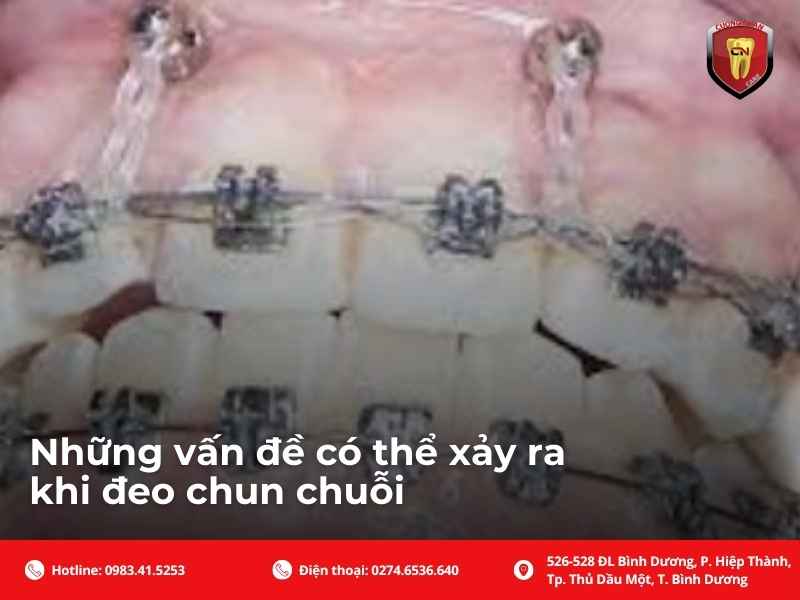 Những vấn đề có thể xảy ra khi đeo chun chuỗi