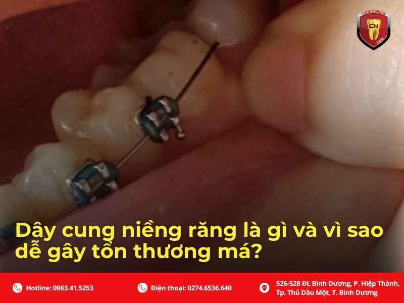 Dây cung niềng răng là gì và vì sao dễ gây tổn thương má?