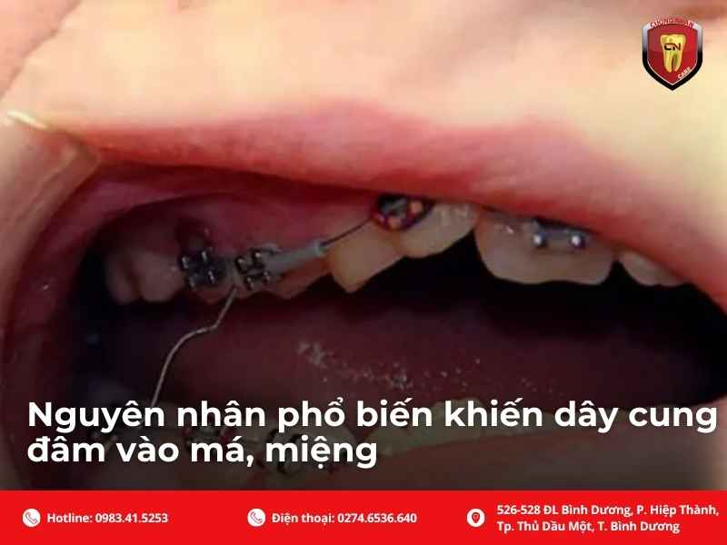 Nguyên nhân phổ biến khiến dây cung đâm vào má, miệng