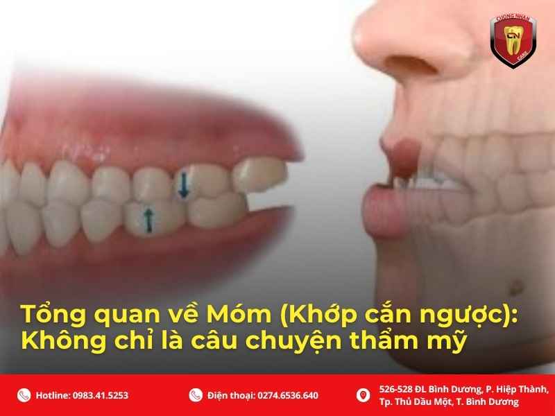 Tổng quan về Móm (Khớp cắn ngược): Không chỉ là câu chuyện thẩm mỹ