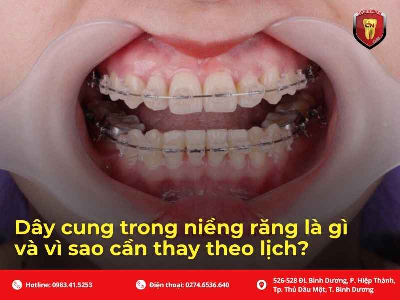Niềng răng bao lâu thì thay dây cung? Giải thích theo từng giai đoạn