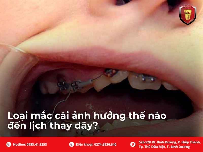 Loại mắc cài ảnh hưởng thế nào đến lịch thay dây?