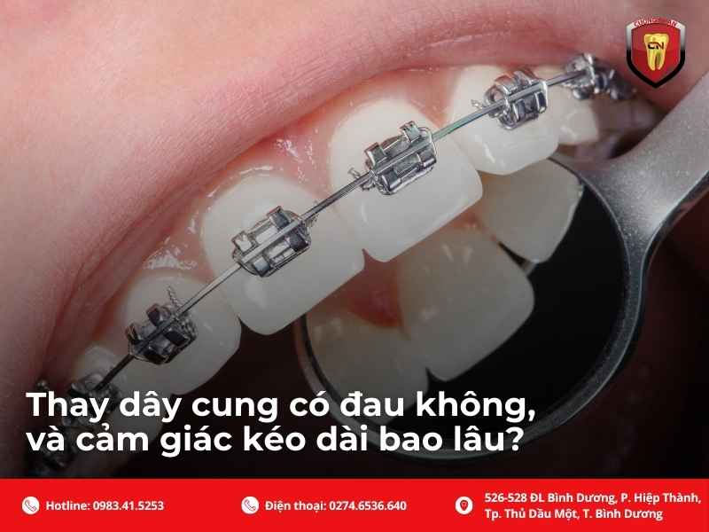 Thay dây cung có đau không, và cảm giác kéo dài bao lâu?