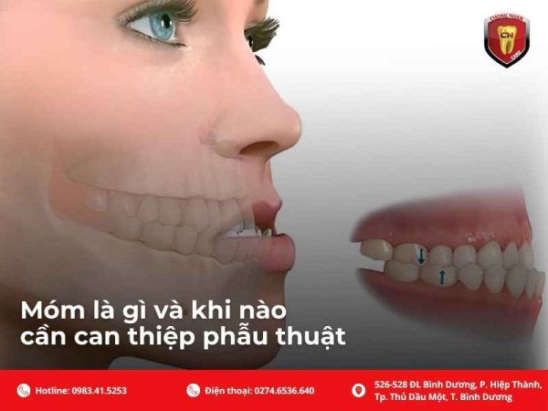 Phẫu thuật hàm móm có nguy hiểm không? Phân tích rủi ro, tỷ lệ biến chứng, gây mê, hồi phục và lưu ý an toàn trước khi mổ.