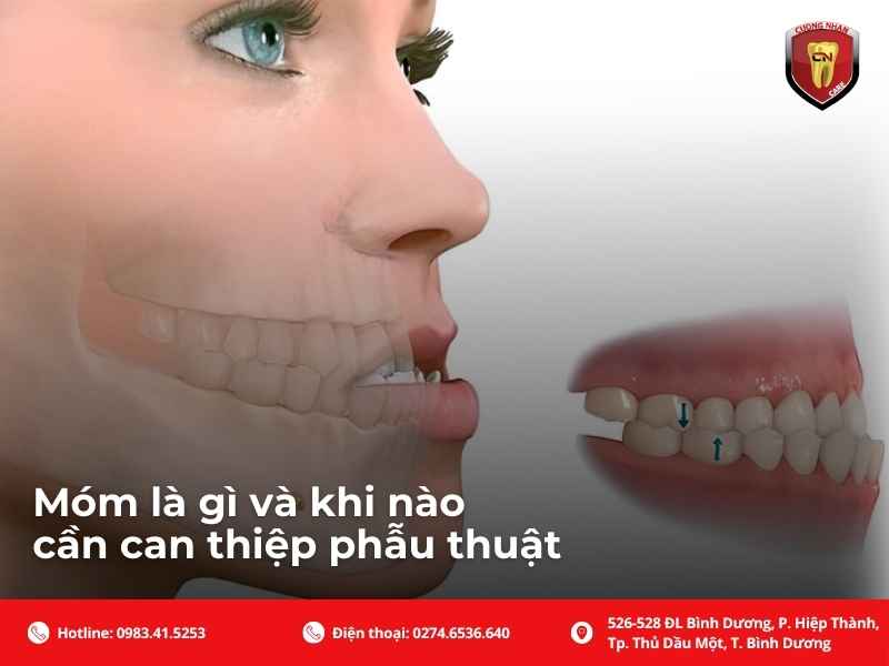 Phẫu thuật hàm móm có nguy hiểm không? Phân tích rủi ro, tỷ lệ biến chứng, gây mê, hồi phục và lưu ý an toàn trước khi mổ.