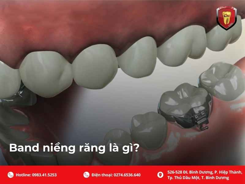 Band niềng răng là gì? Bài viết giải thích khâu chỉnh nha, cấu tạo hook–tube, khi nào cần gắn, đau không, thun tách kẽ, cách vệ sinh và xử lý band lỏng.