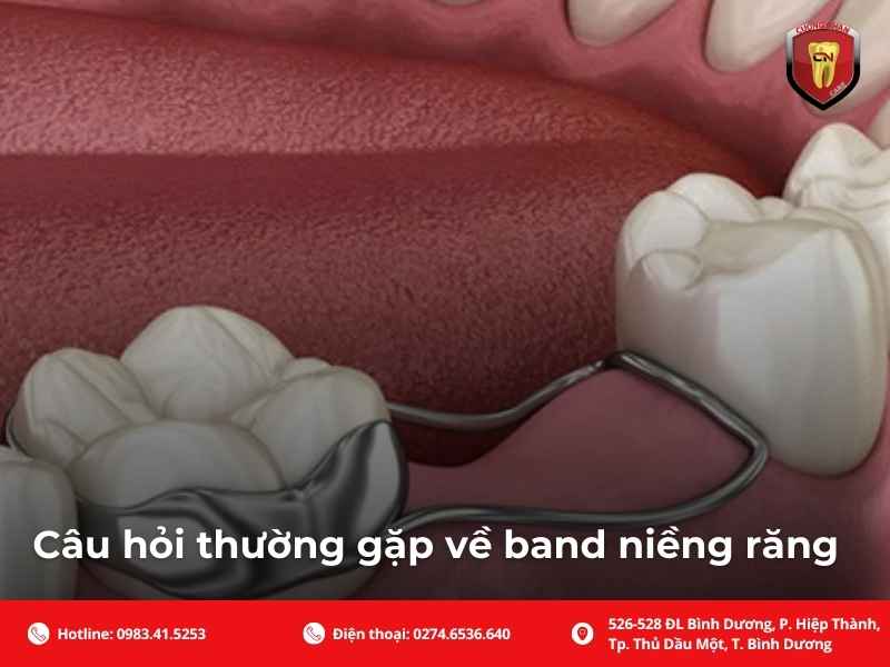 Câu hỏi thường gặp về band niềng răng