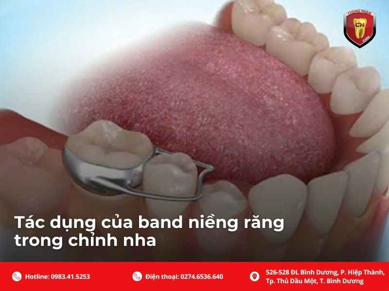 Band niềng răng là gì?