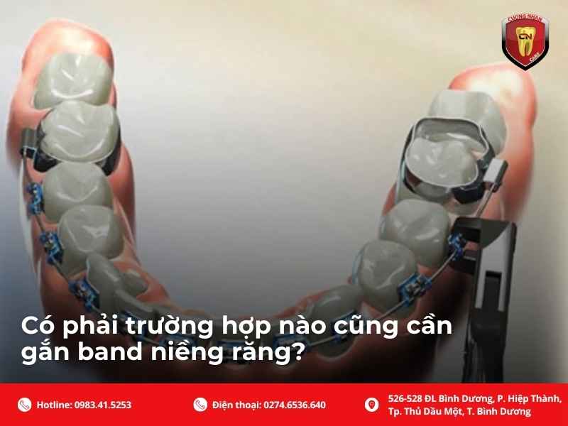 Tác dụng của band niềng răng trong chỉnh nha