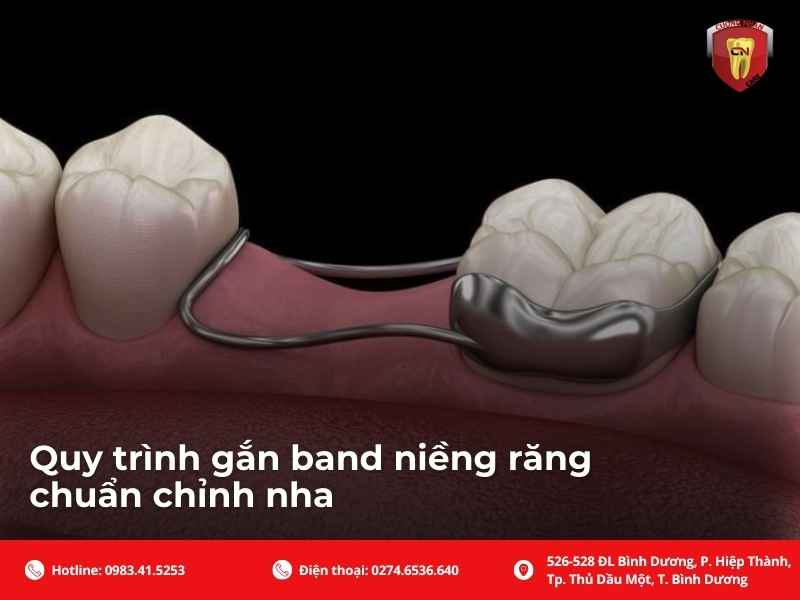 Band niềng răng khác gì mắc cài dán trực tiếp ở răng hàm?
