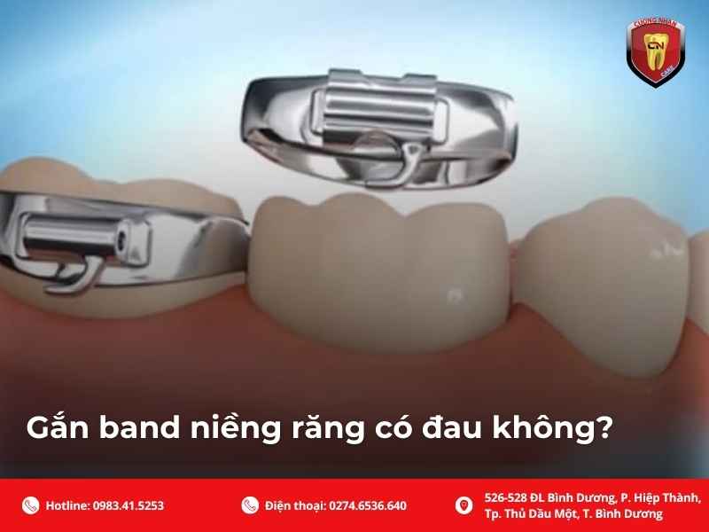 Quy trình gắn band niềng răng chuẩn chỉnh nha