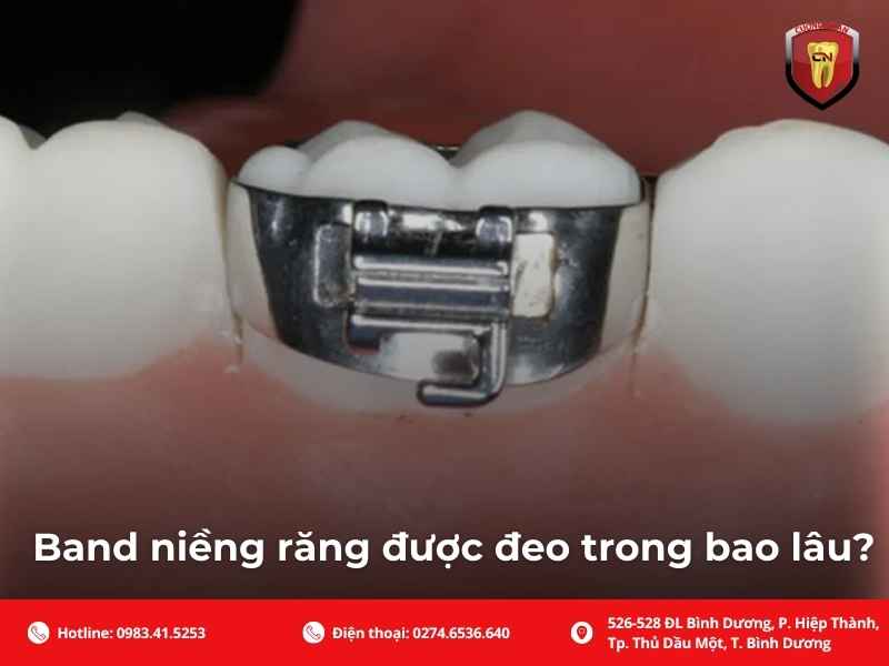 Gắn band niềng răng có đau không?