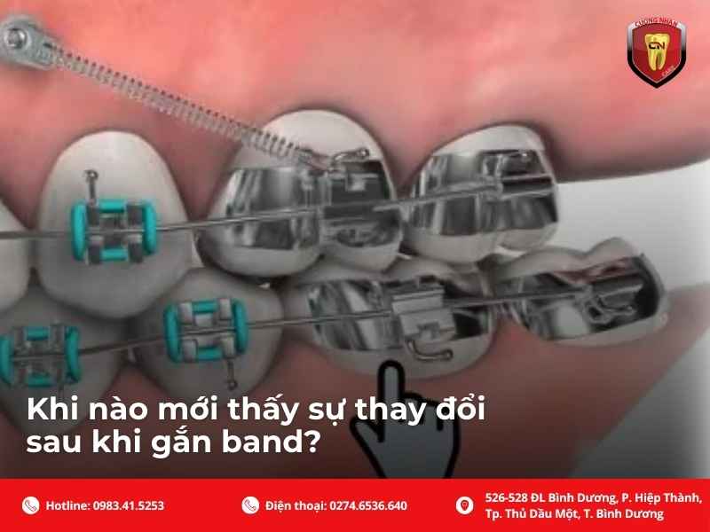 Band niềng răng được đeo trong bao lâu?