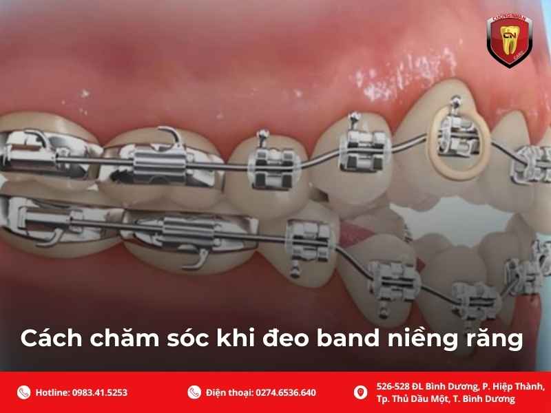 Cách chăm sóc khi đeo band niềng răng