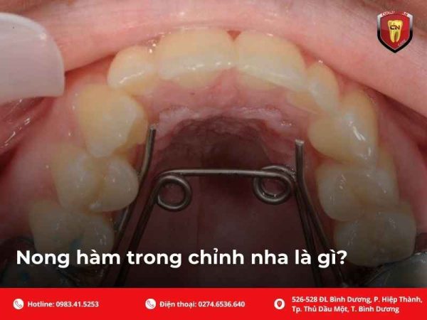 Nong hàm trong chỉnh nha là gì?