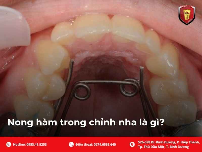 Nong hàm trong chỉnh nha là gì?