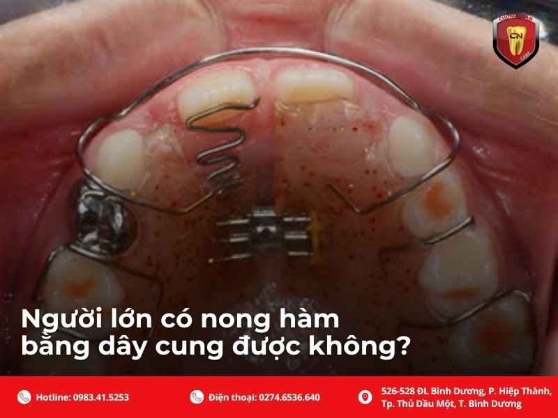 Người lớn có nong hàm bằng dây cung được không?
