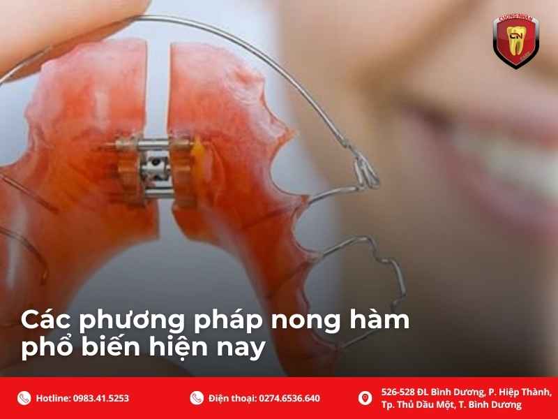 Các phương pháp nong hàm phổ biến hiện nay