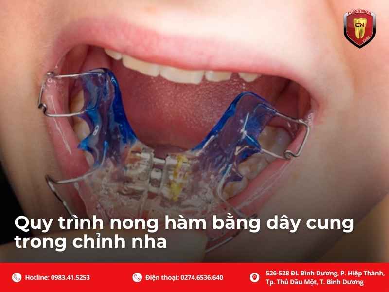 Quy trình nong hàm bằng dây cung trong chỉnh nha