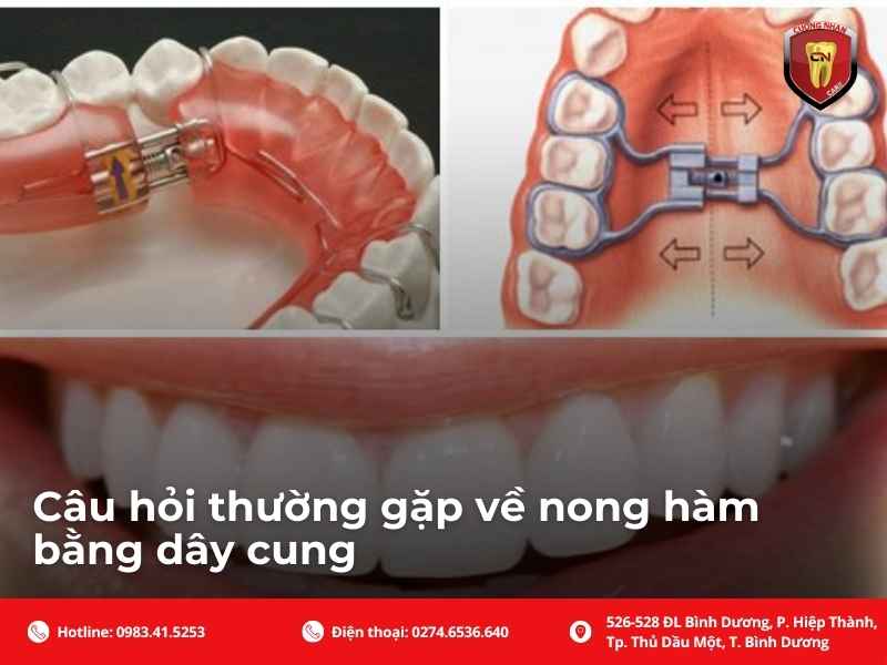 Câu hỏi thường gặp về nong hàm bằng dây cung