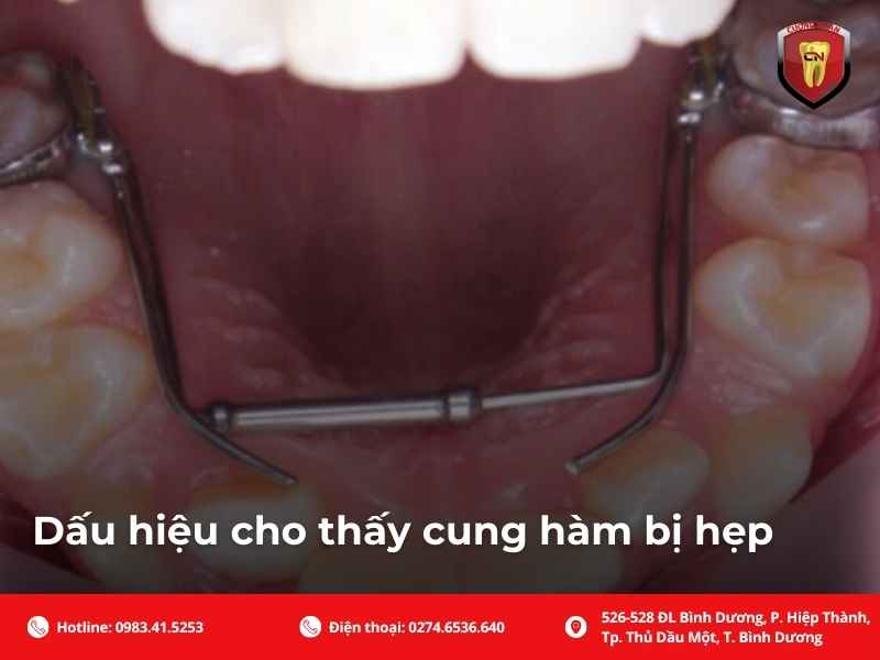 Dấu hiệu cho thấy cung hàm bị hẹp