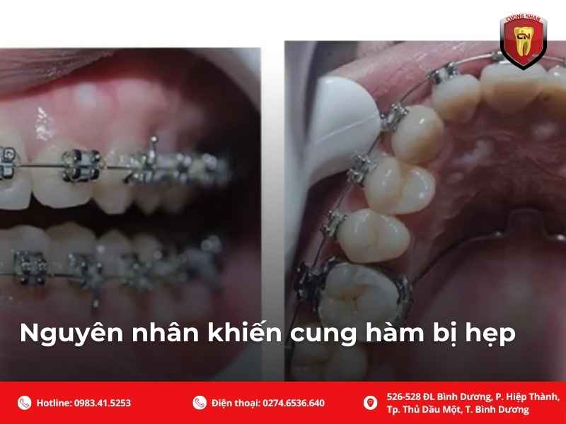 Nguyên nhân khiến cung hàm bị hẹp