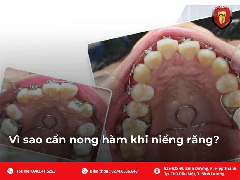 Vì sao cần nong hàm khi niềng răng?