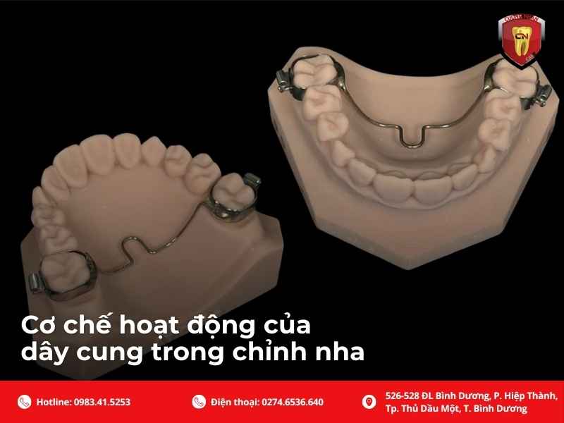 Cơ chế hoạt động của dây cung trong chỉnh nha