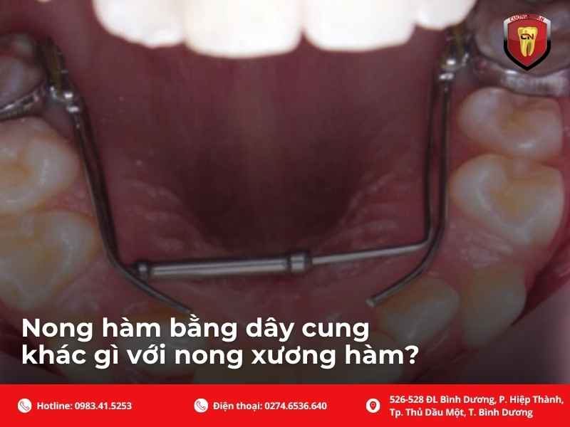 Nong hàm bằng dây cung khác gì với nong xương hàm?