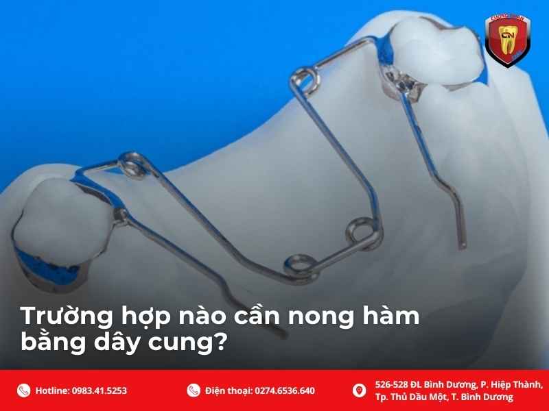 Trường hợp nào cần nong hàm bằng dây cung?