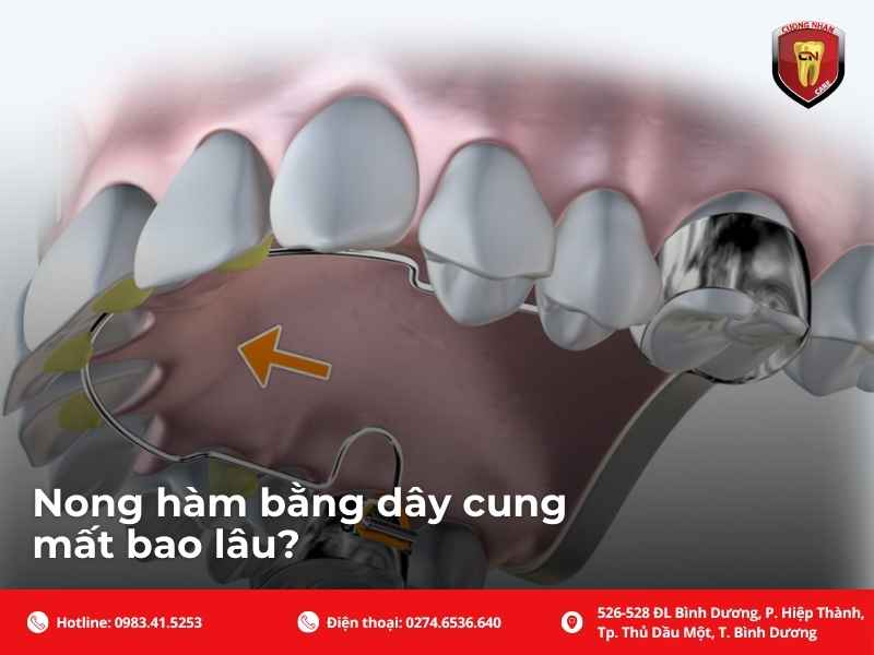 Nong hàm bằng dây cung mất bao lâu?