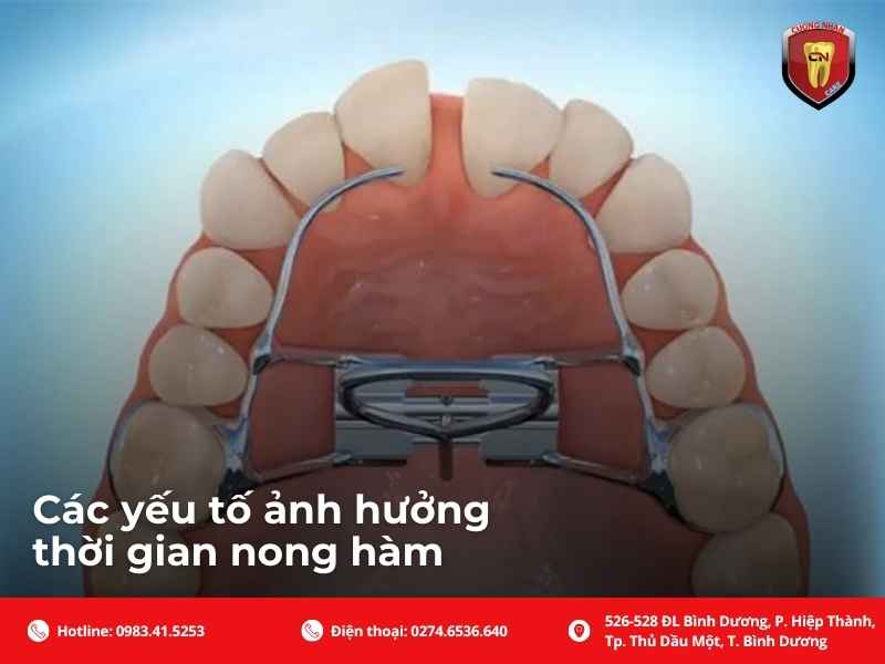 Các yếu tố ảnh hưởng thời gian nong hàm