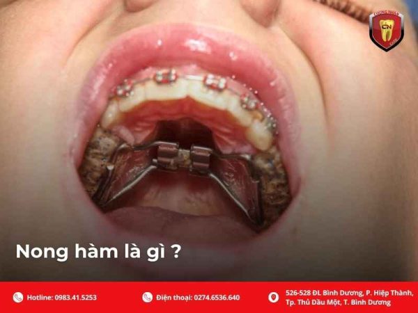 Nong hàm có đau không? Nha khoa Cường Nhân sẽ giải thích cảm giác khi đeo khí cụ nong hàm, cách giảm khó chịu, lưu ý vệ sinh, thời gian thích nghi, khác biệt trẻ em và người lớn.