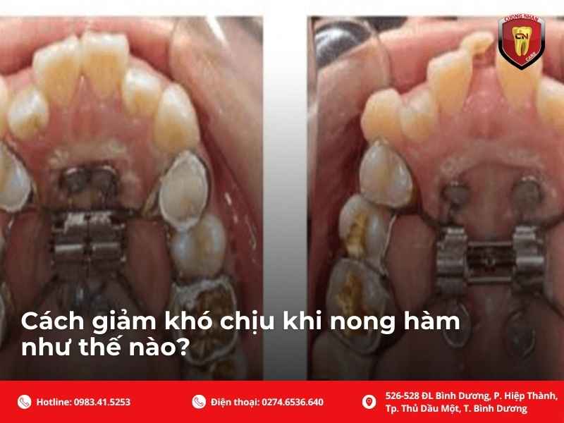 Thời gian nong hàm bao lâu ? Khi nào cảm thấy khó chịu nhất ?