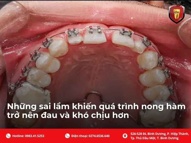 Cách giảm khó chịu khi nong hàm như thế nào?
